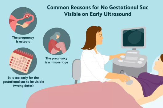 KHÔNG THẤY TÚI THAI TRÊN SIÊU ÂM CÓ NGHĨA LÀ TÔI KHÔNG MANG THAI?