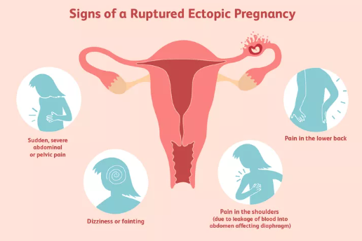 Những Điều Cần Biết Về Thai Ngoài Tử Cung Vỡ