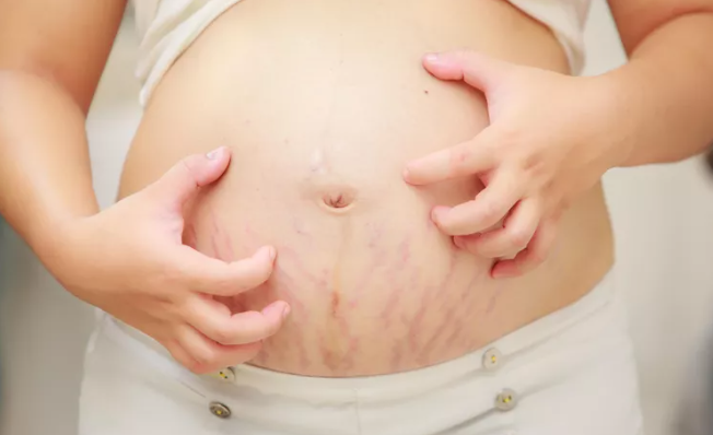 Làm Thế Nào Để Điều Trị Tình Trạng Ngứa Da Trong Thai Kỳ?